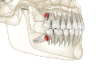 親知らずの痛みをイメージしたレントゲン画像