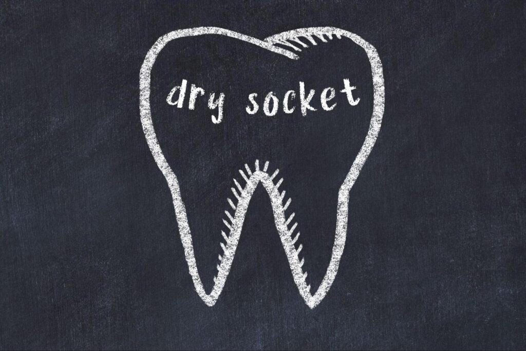 歯のイラストとdry socketという文字